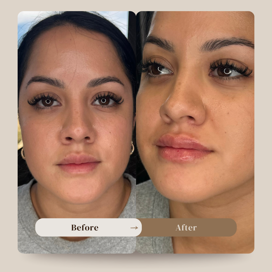 Lip Filler at ReBourne Aesthetics and Wellness in Ridgland, MS