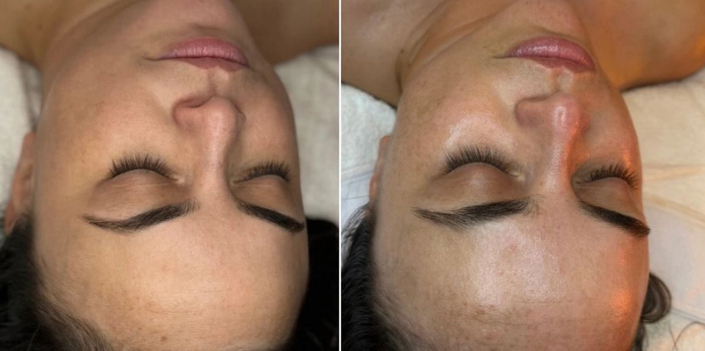 Chemical Peel Facial