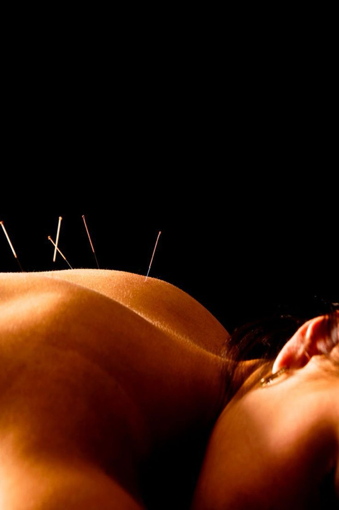 FOLLOW-UP ACUPUNCTURE SESSION