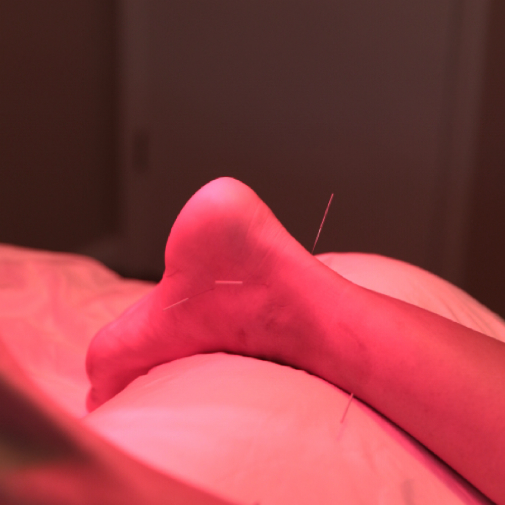 FOLLOW-UP ACUPUNCTURE SESSION