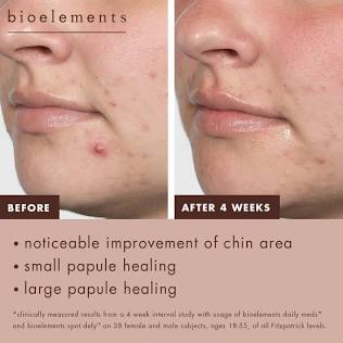 Acne Facial