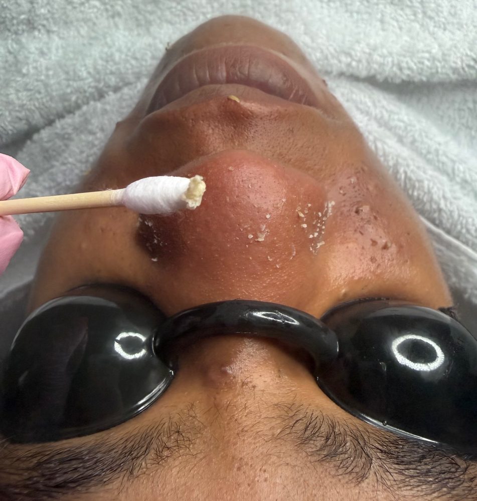 Extraction/Acne Facial