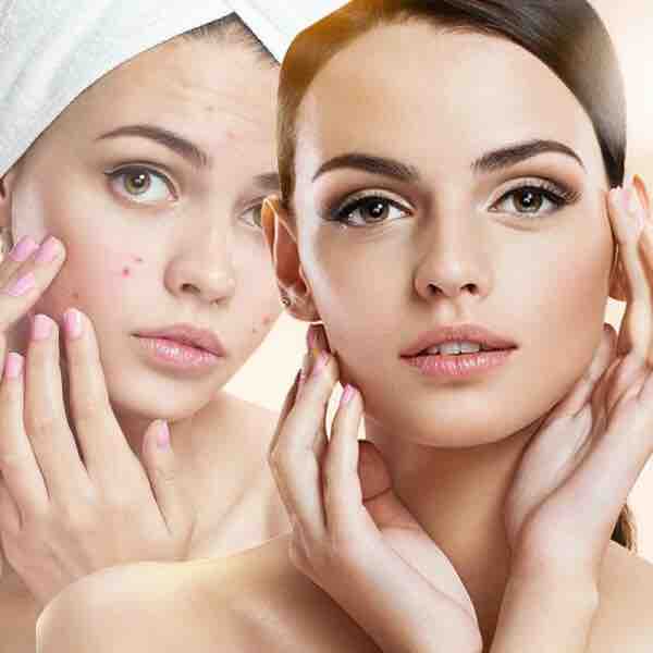 Acne Facial