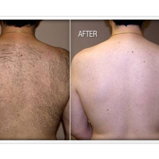 Back Laser Hair Removal at The Beautee Spot in Phoenix, AZ