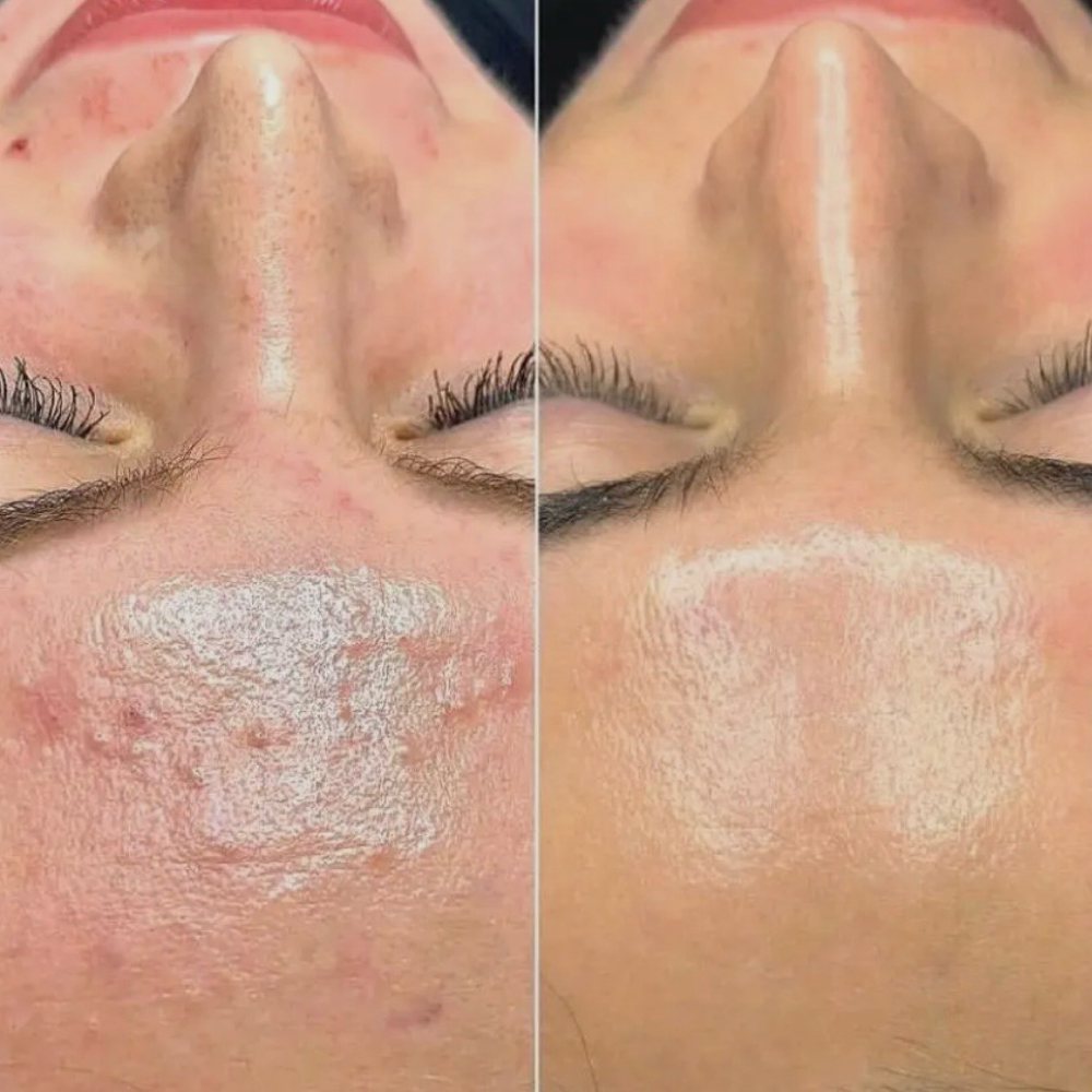 Chemical Peel at Bella Lash & Beauty in Cedar Grove, NJ