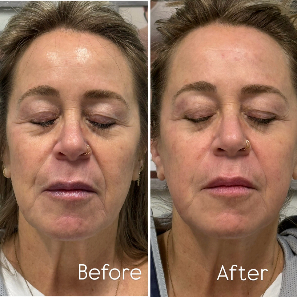 Advanced Facial Rejuvenation -TMJ at Spa and Sculpting by Roza in Charlotte NC, NC