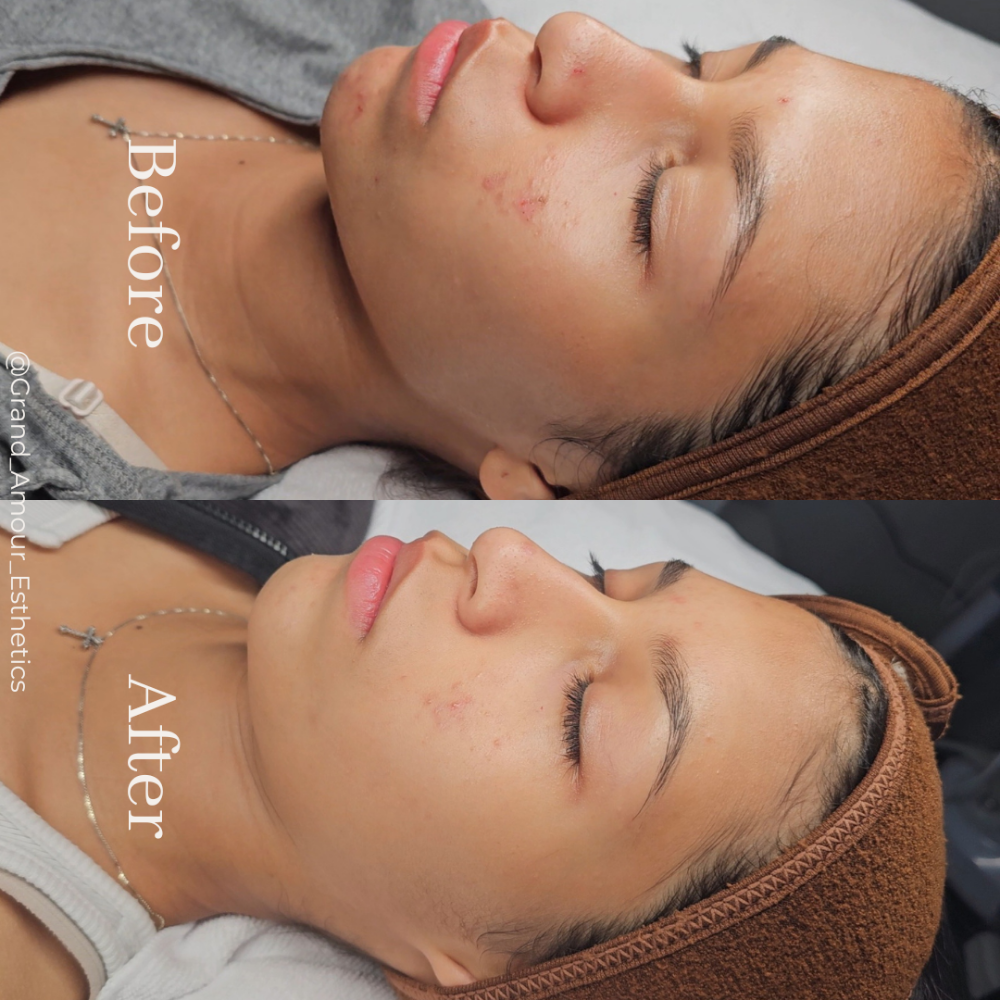 Teen Classic Facial