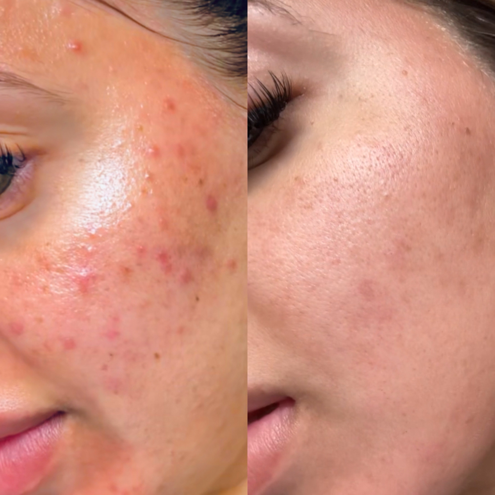 Skin Consulation