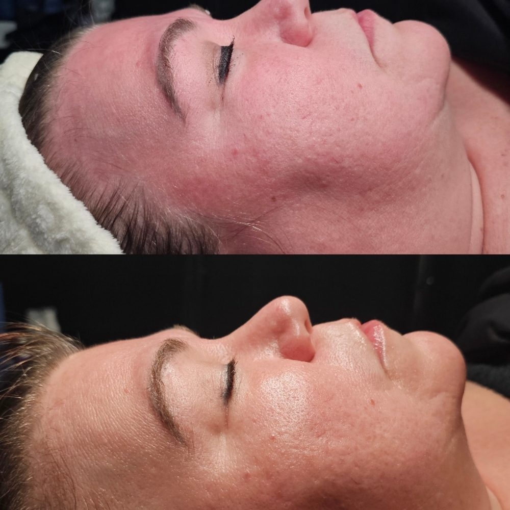 The Rosacea Facial at Aligned Beauty & Wellness in Davenport, IA