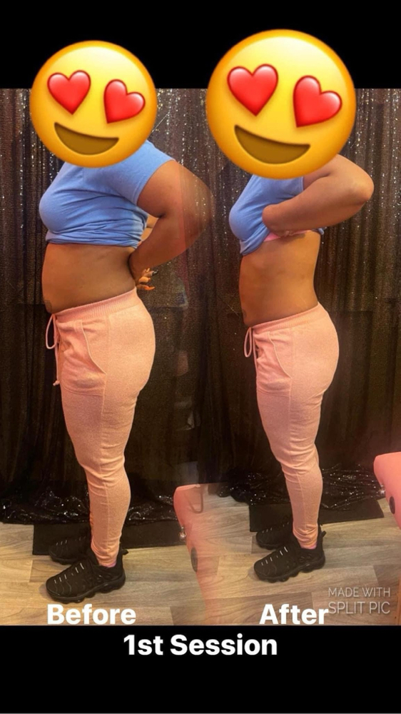 Laser/Lipo
