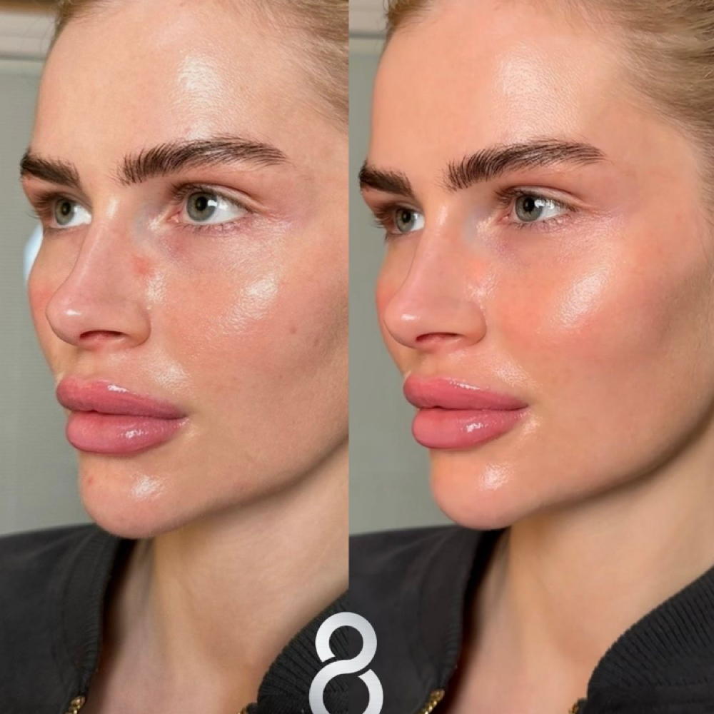 Fusion 8 Facial at Sanazskincenter in Vienna, VA