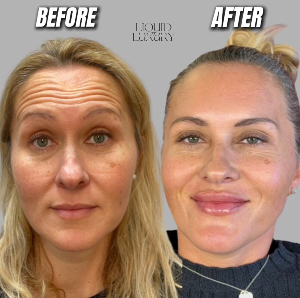 Full Face Rebalancing With Jeuveau
