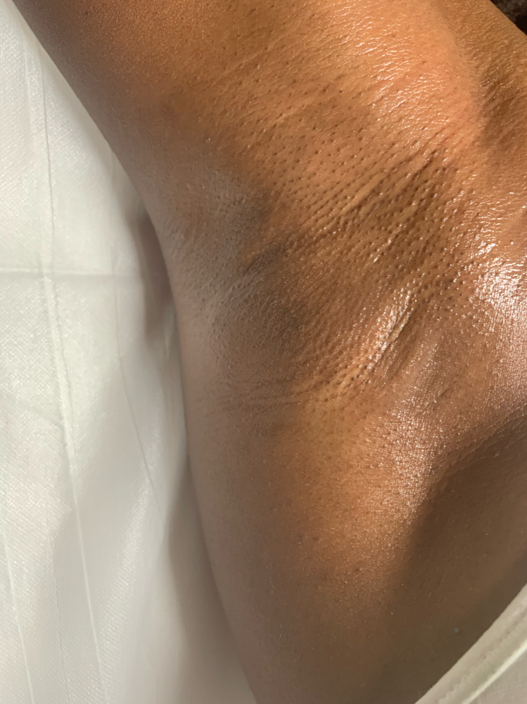 Underarms