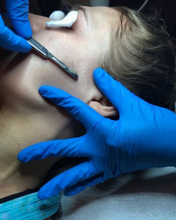 Dermaplane Facial