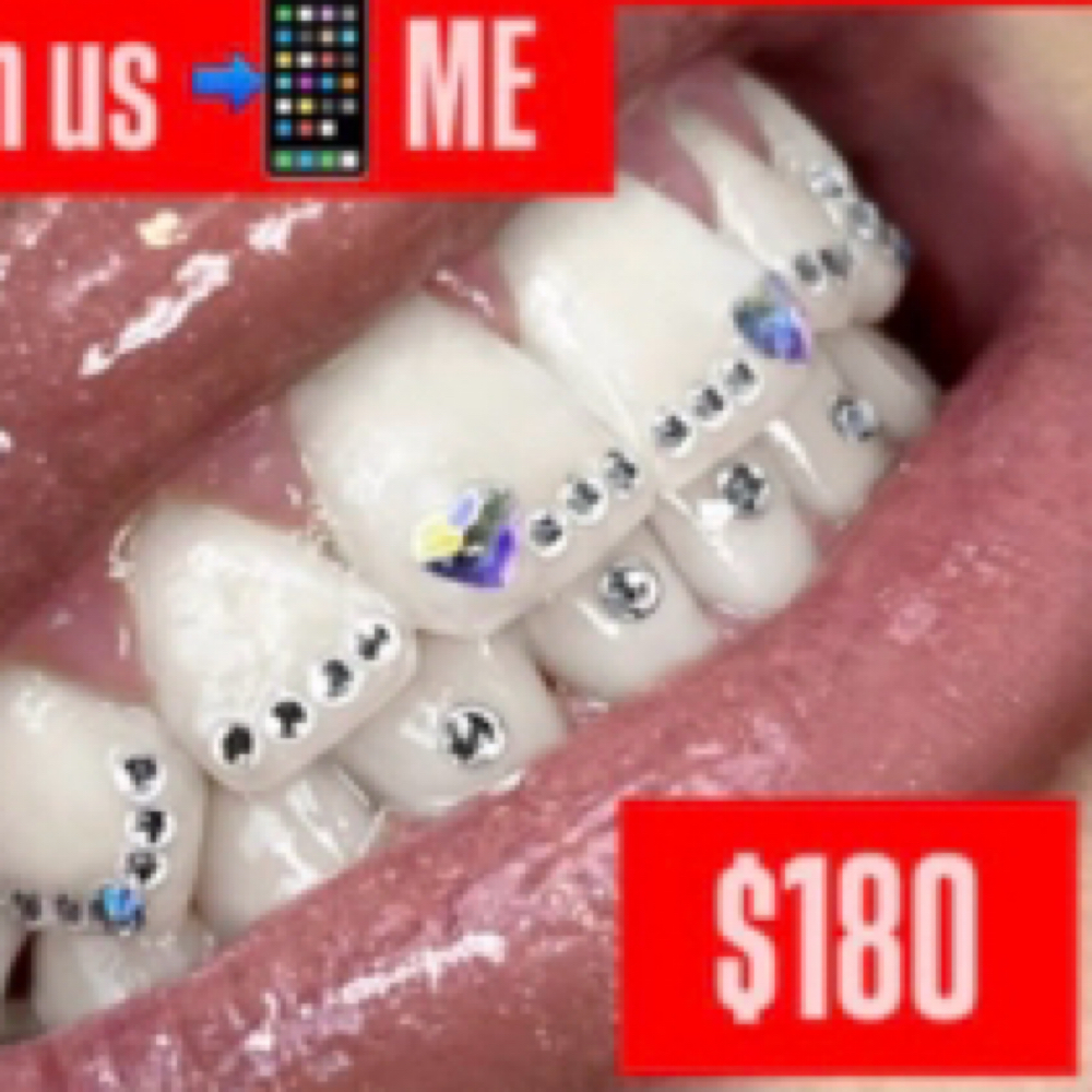 Tooth Gem App. Full Freestyle Set at Icey Whites By Blondee in Lawrence, MA