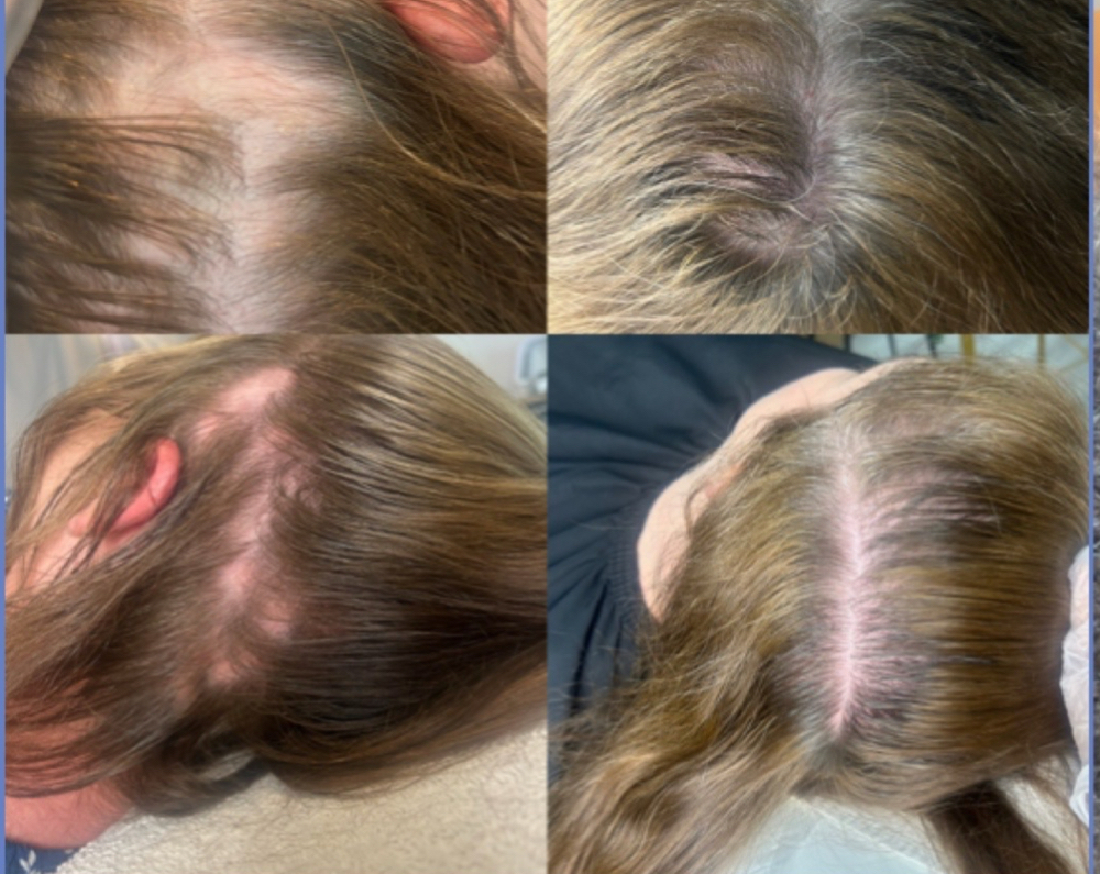 HFS GROWTH FACTOR RESTORATION