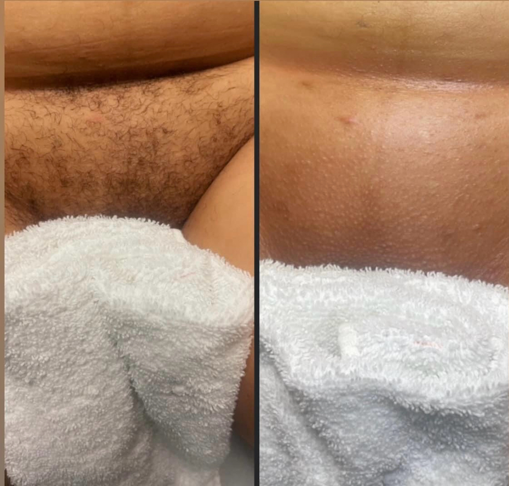 Brazilian Wax