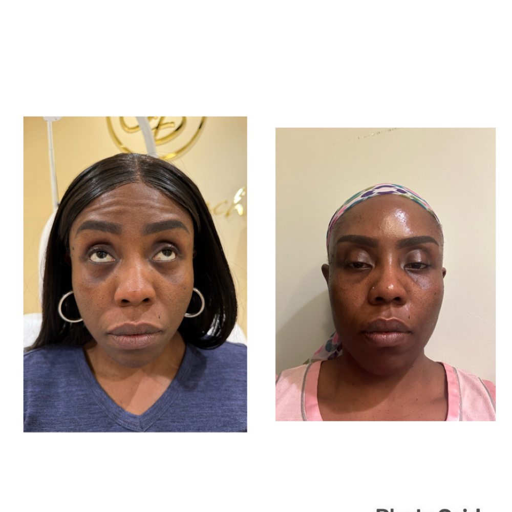 Wrinkle Relaxer at Olive Branch Medspa in Los Angeles, CA