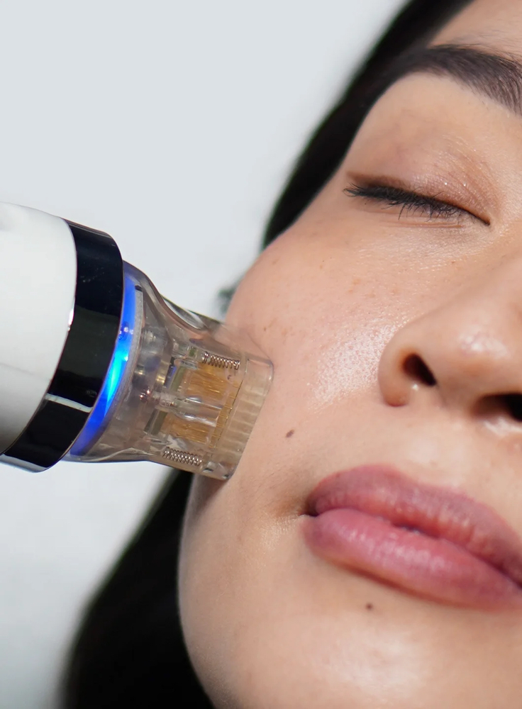 Radio Frequency Microneedling