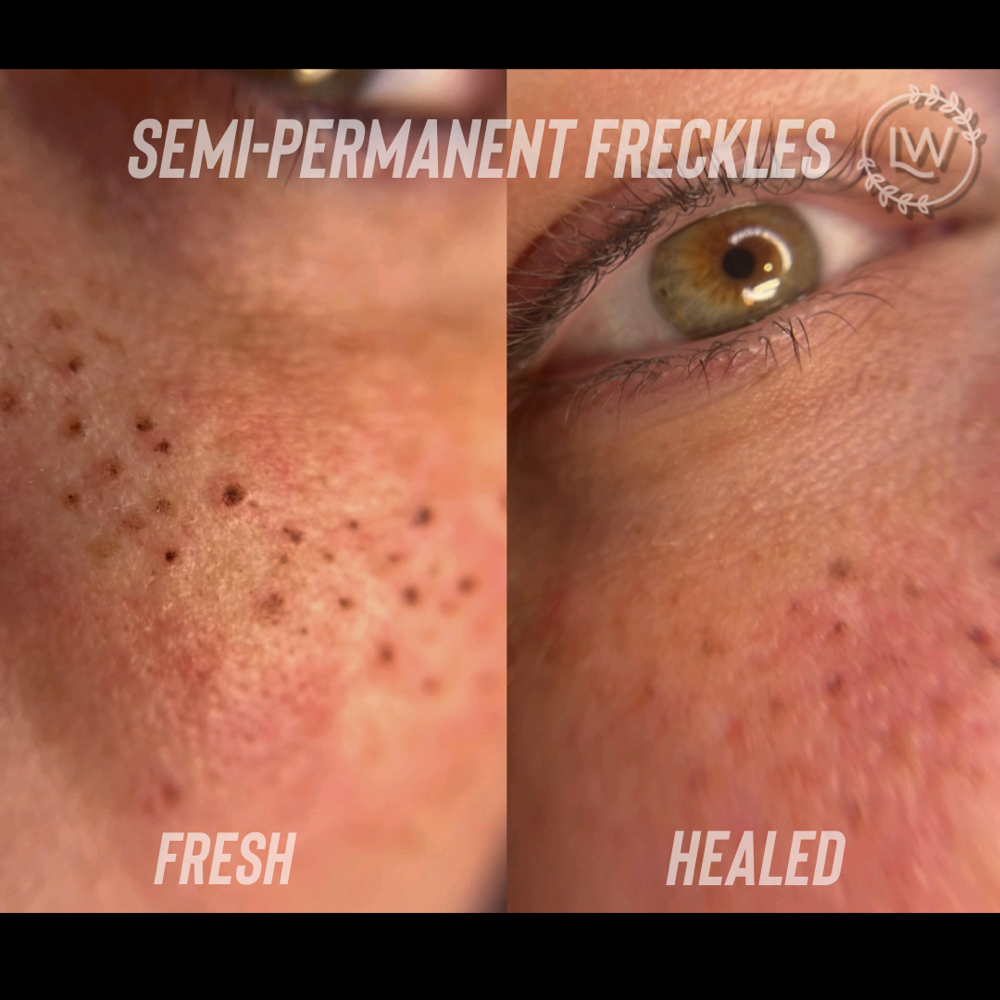 Semi-Permanent Freckles