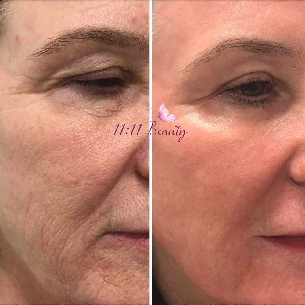 Full Face Fibroblast