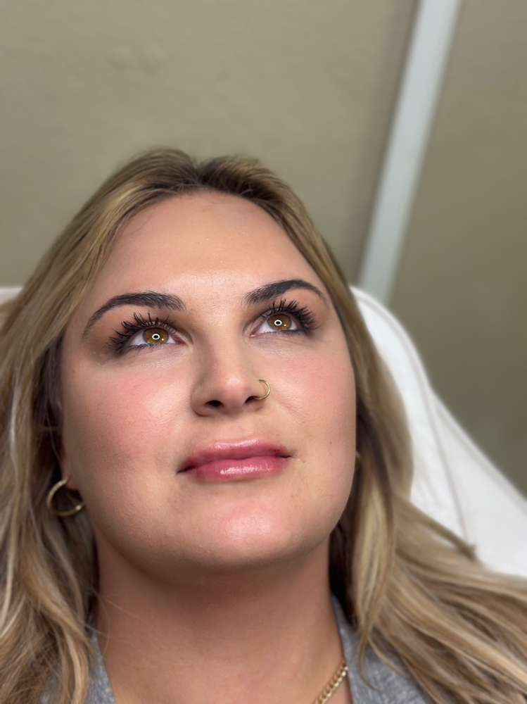 Lip Filler