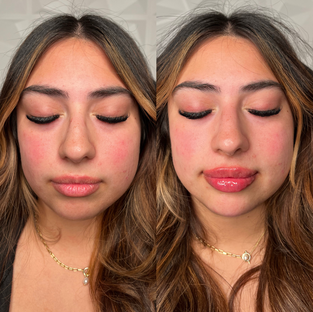Chin Filler