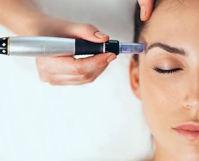 Microneedling Face, Neck and Chest