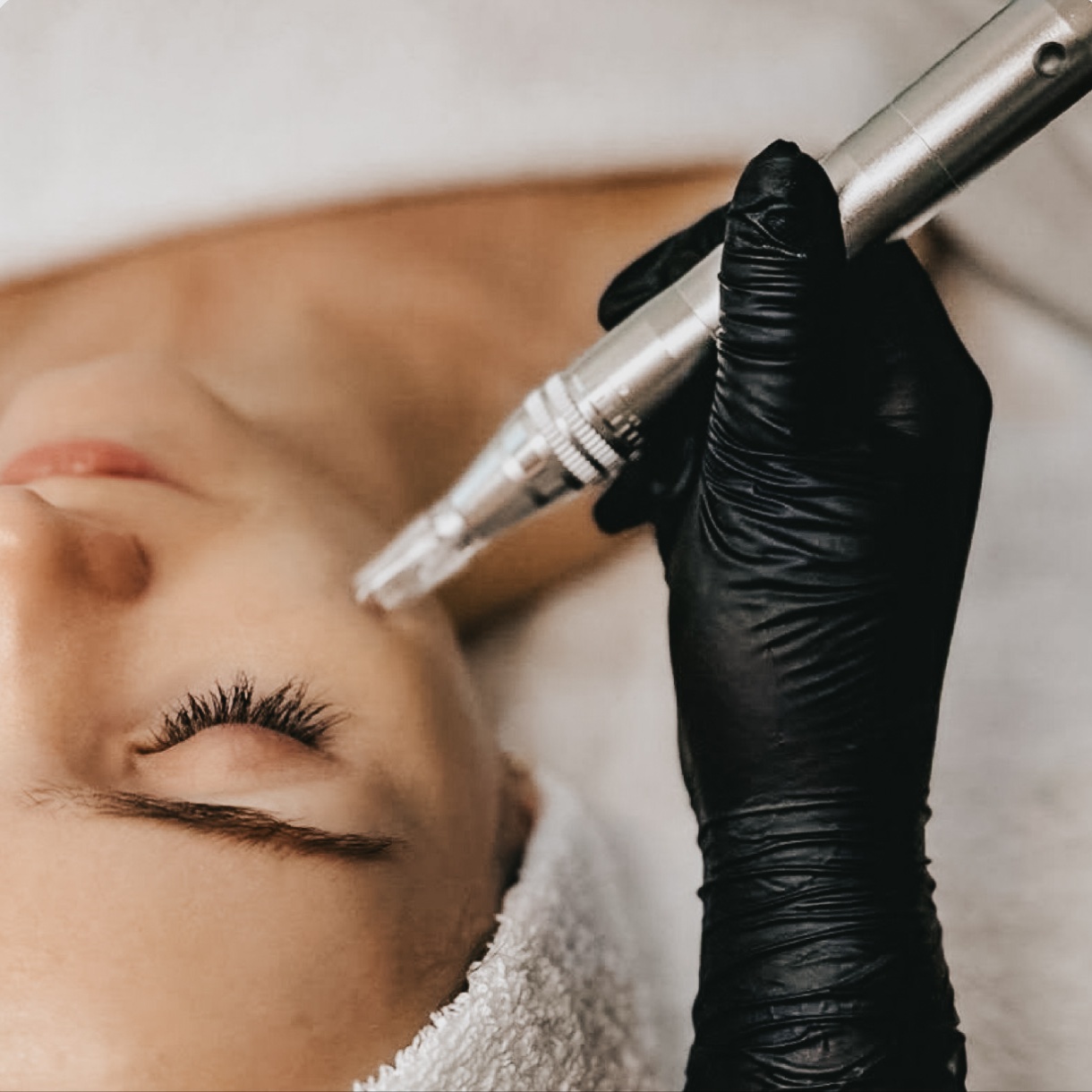 Nano-Needling Face, Neck & Dec at SKN by Rachel in Summerville, SC