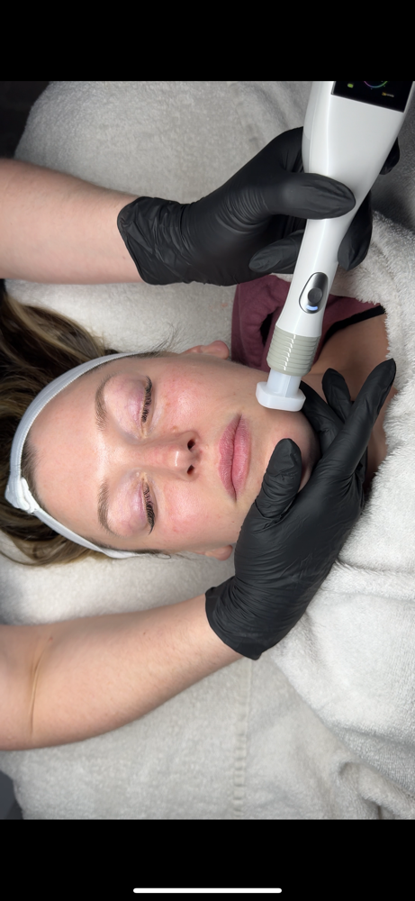 Jet Plasma 1st Treatment $325 PROMO