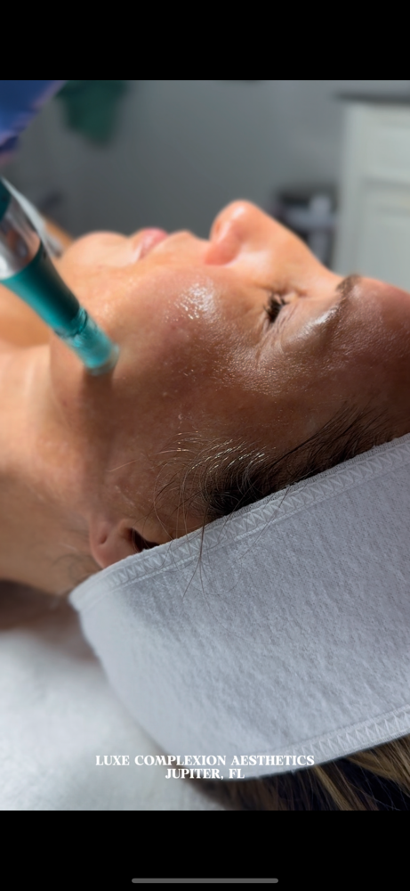 Microneedling Session