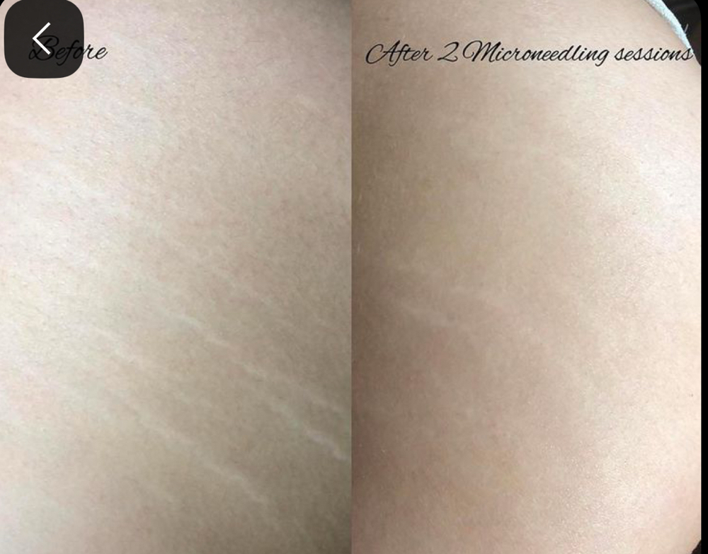 Microneedling Stretch Marks/ Body