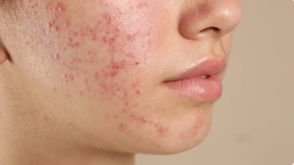 Acne Program at Laura Fabral Aesthetics in Miami, FL