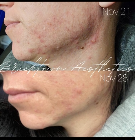 Acne Fighting PlasmaPen Treatment