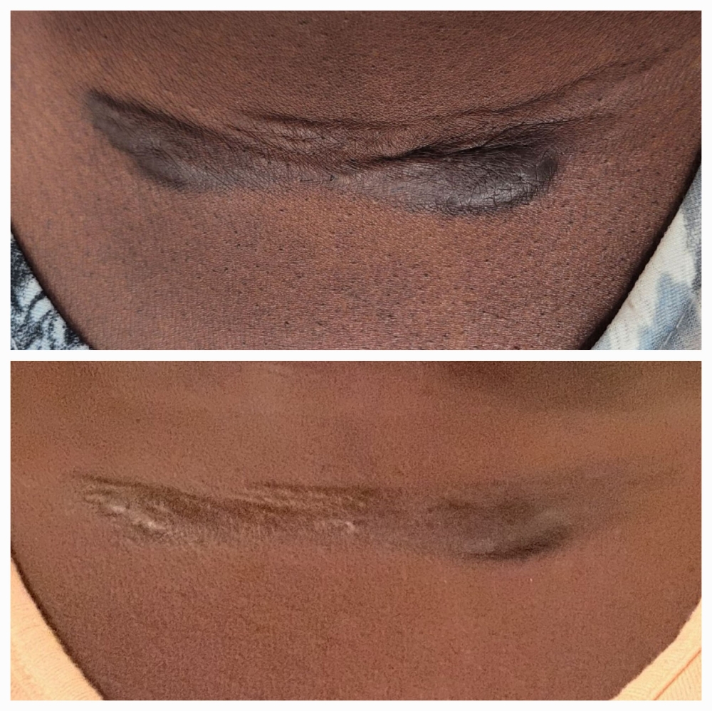 Inkless Scar Treatment