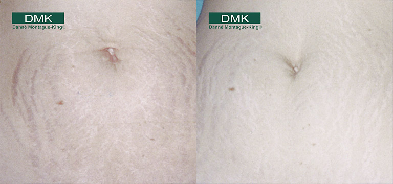 DMK body treatment