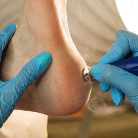 Calluses Treatment Only