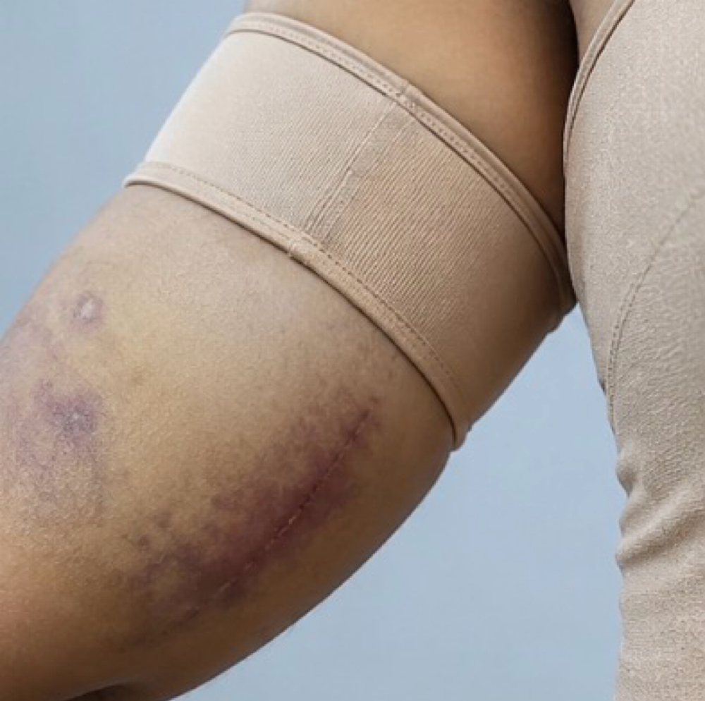 Arms Post-Op Recovery at Healing Touch by Tasha in Tarzana, CA
