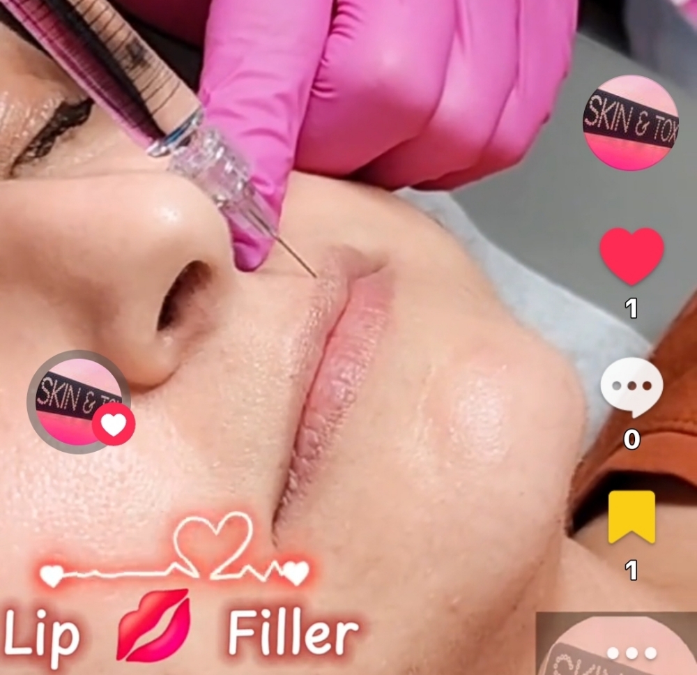 Derma Filler at Skin & Toxx in Houston, TX