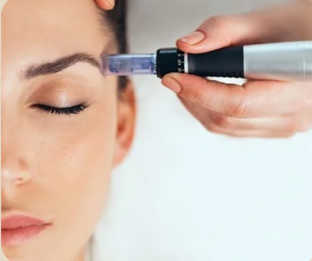 Microneedling