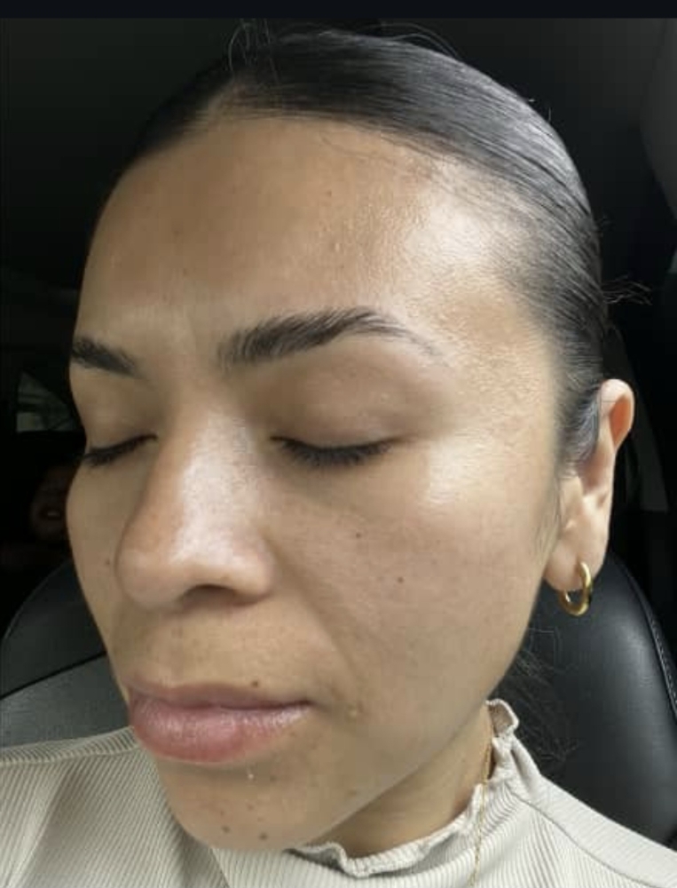Anti-aging Chemical Peel