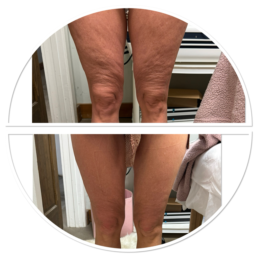 Cellulite Treatment!  (4 Sessions)