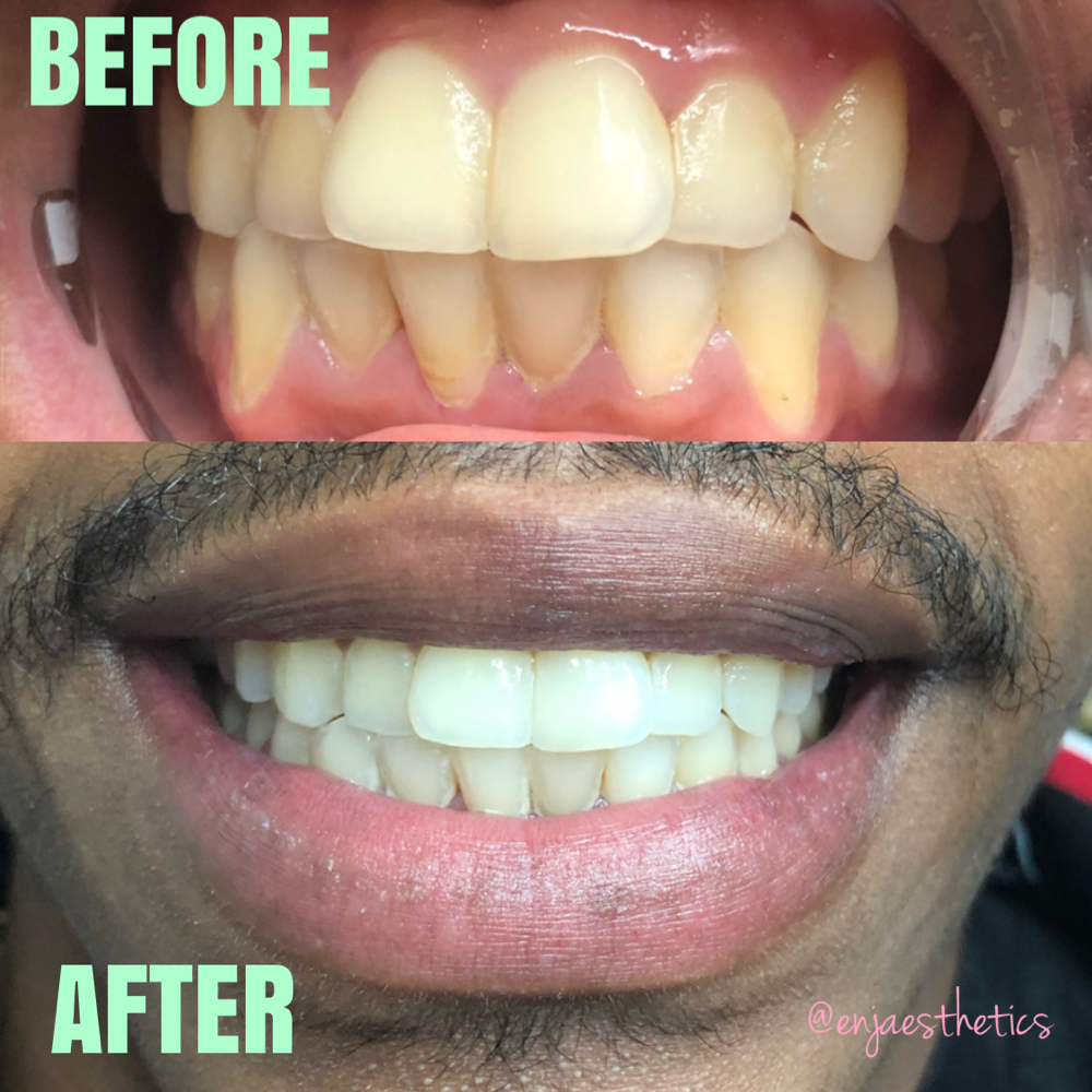 Teeth Whitening