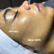 Dermaplaning  GLOW GLOW