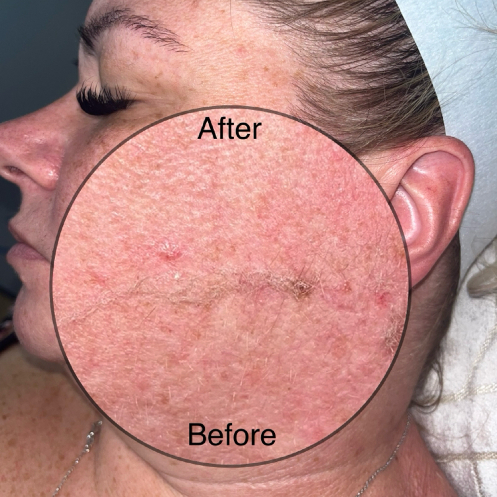 Dermaplane Facial at Blissful Brows & Lashes in Thornton, CO
