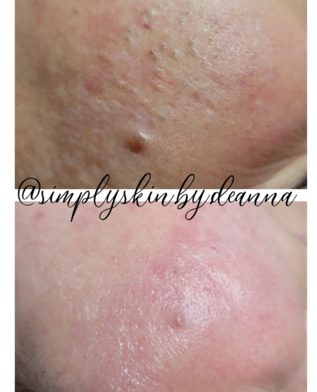 Acne Facial w/ Decollete Service