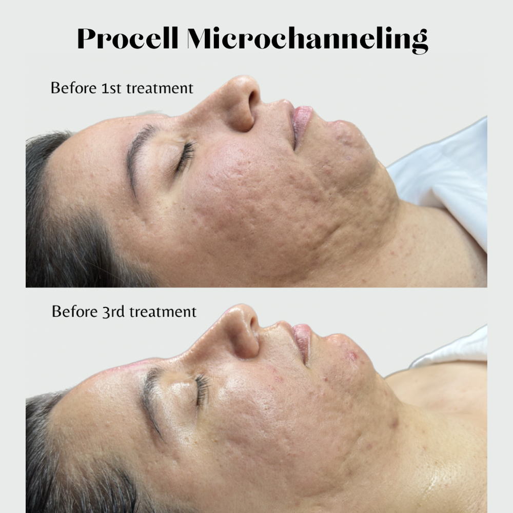 Procell Microchanneling