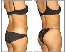 5D Stomach Laser Lipo - 6