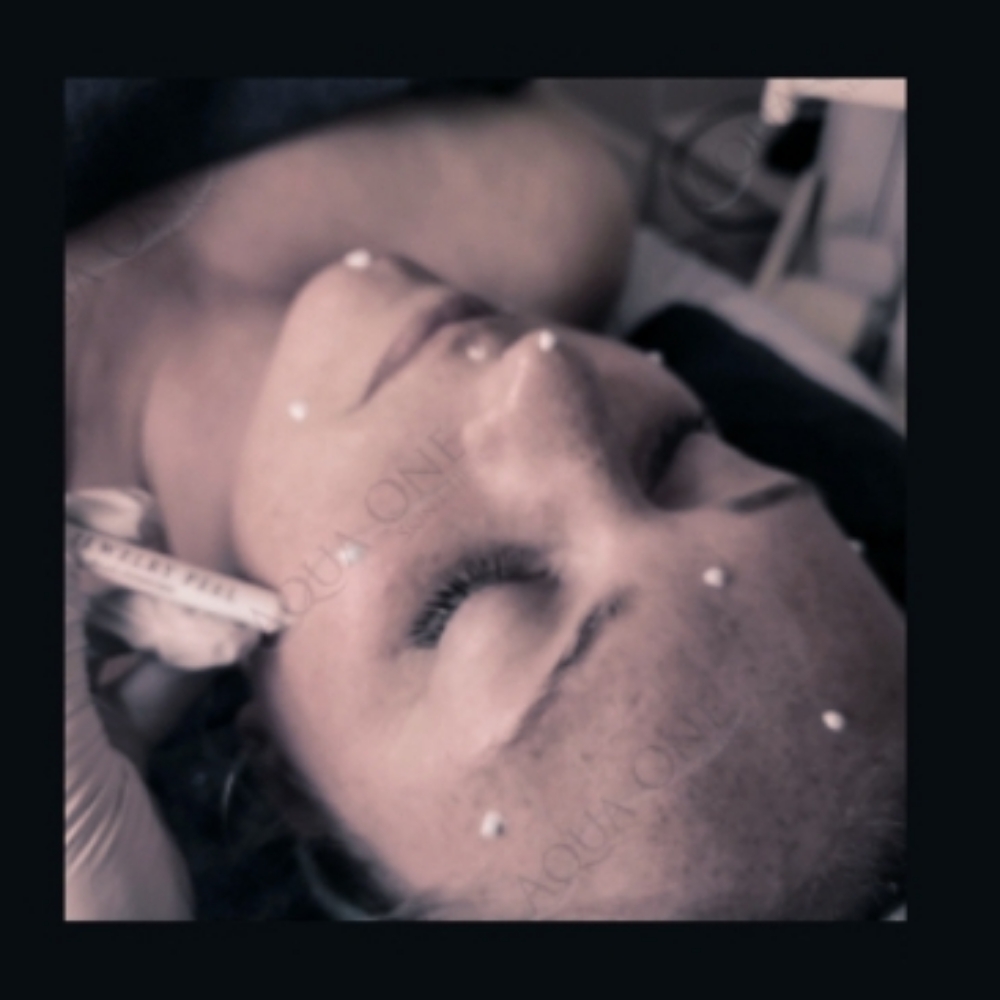 BioMicroneedling Diamond Princess at Aqua One Skin Clinic in Jasper, IN