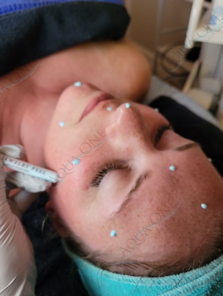 BioMicroneedling Diamond Princess